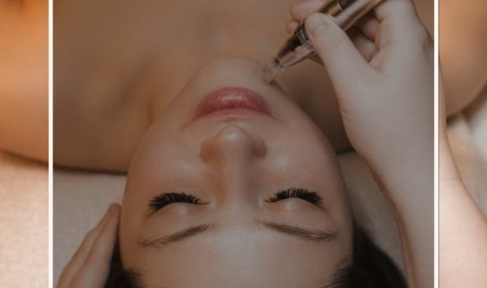 5 Reasons You Need to Try Microneedling